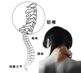 頸椎病是什么原因引起的？王九正貼改善頸椎病效果好！_1