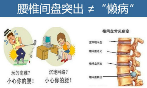 改善腰间盘突出快速有效的方法是什么呢_1