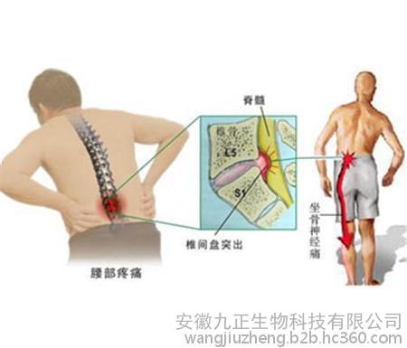 专家总结改善腰椎间盘突出的西医疗法和中医疗法的区别_1