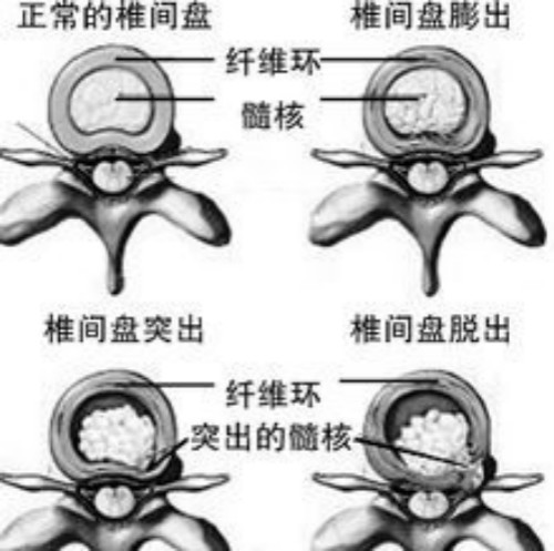 治好腰間盤突出勢在必行，這樣才能擺脫_1