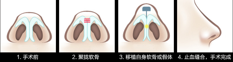 仪美医疗美容－鼻小柱整形（图）_1