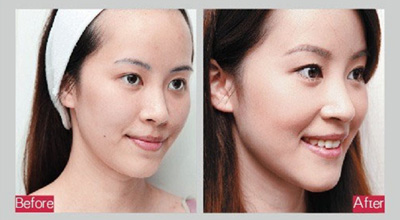 商丘自體脂肪填充哪家醫(yī)院好？（圖）_3