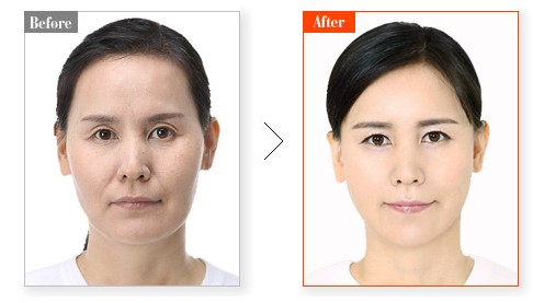 商丘自體脂肪填充哪家醫(yī)院好？（圖）_4