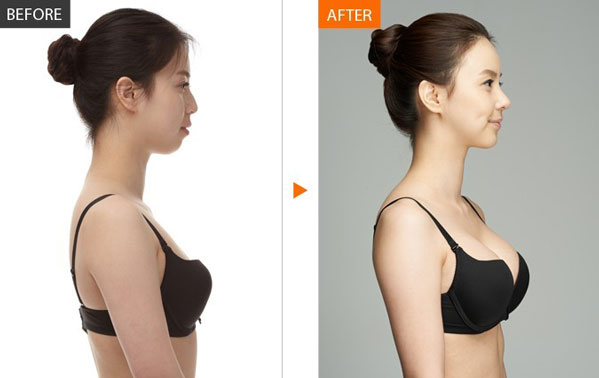 商丘自體脂肪填充哪家醫(yī)院好？（圖）_5