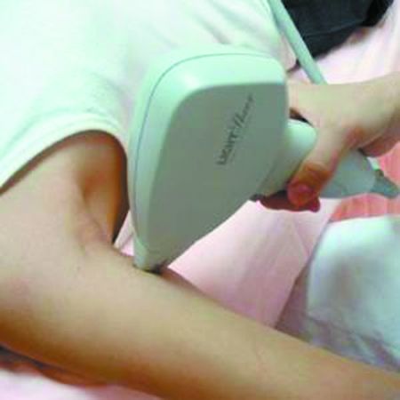 opt脫毛儀器哪個牌子好（圖）_1