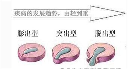 對于腰椎間盤突出你到底知道多少？_2
