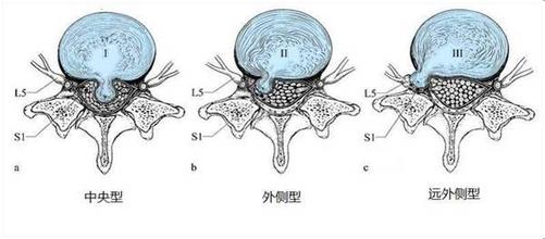 腰椎间盘突出?，?症状?花样百出，你中了哪些招？_2