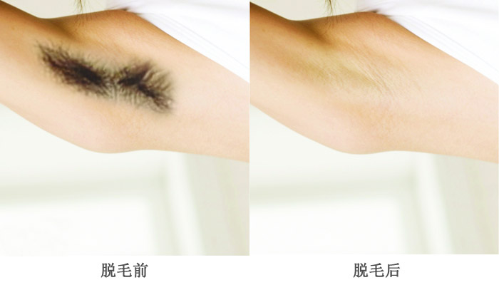 無(wú)痛脫毛儀器哪種好（圖）_1