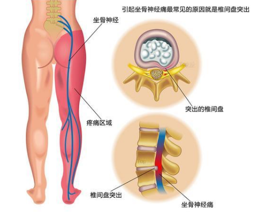 坐骨神经痛于腰椎间盘突出交汇，中西改善大全！_1