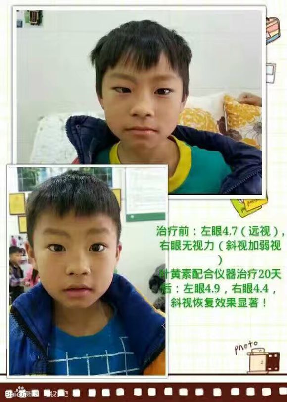 弱視是什么? 5-8歲孩子的父母必須看...（圖）_2