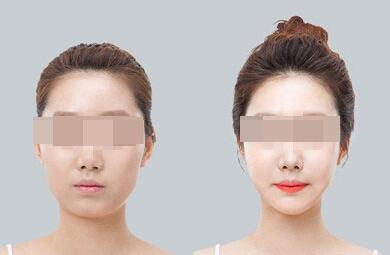 商丘打瘦臉針多少錢？（圖）_1