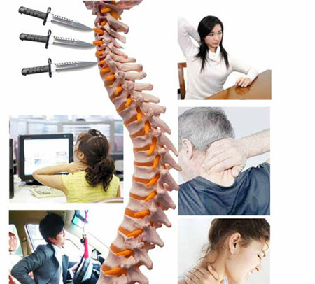 腰椎骨质增生的四种类型和最有效改善方法（图）_1
