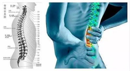 腰椎骨质增生的四种类型和最有效改善方法（图）_2