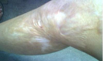 怎樣去燙傷疤痕消除燙傷疤痕的方法_1