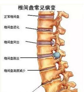 白领小心起来，腰肌劳损开始青睐你了_1