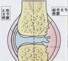 改善滑膜炎祖國醫(yī)學的一朵奇葩膏藥王九正貼_1