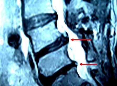 腰椎間盤突出癥引發(fā)坐骨神經(jīng)痛怎么辦？怎樣簡(jiǎn)單有效改善？_1
