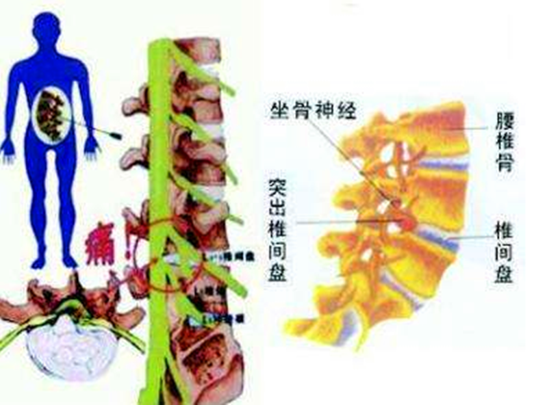 當下埋線法改善腰椎間盤突出效果非常棒_1