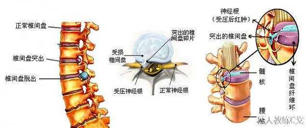一招防治腰間盤突出，不信你試試看？_1