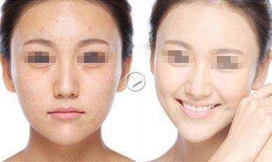 祛斑儀器有效果嗎（圖）_1