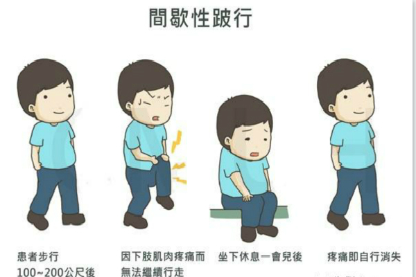 患有腰椎間盤突出治病之前先了解癥狀（圖）_2