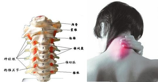 總結(jié)幾種改善頸椎病有效果的方式_1