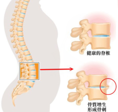 骨質(zhì)增生疼痛時(shí)吃止痛藥有效果嗎 可以改善嗎_1