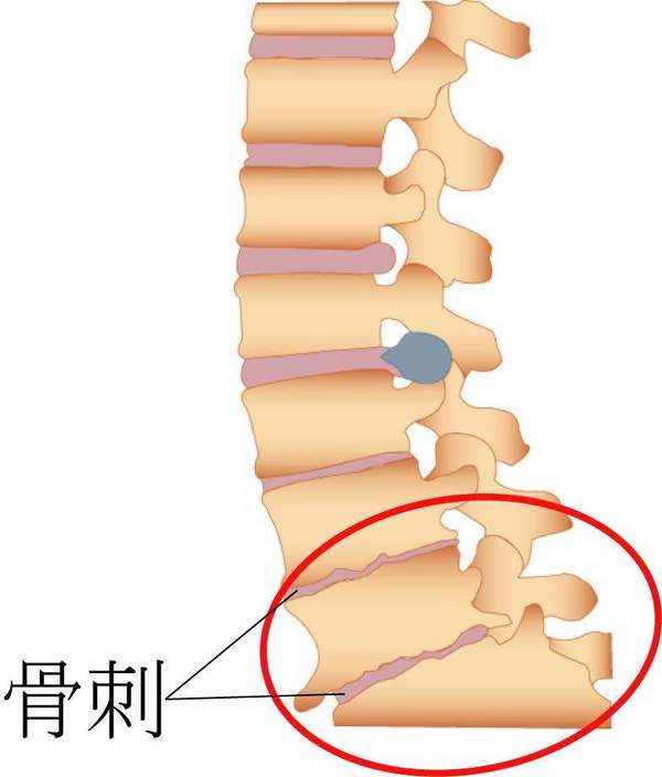 怎样改善骨刺最安全有效，好的最快？_1