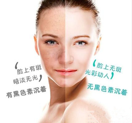 皮秒激光祛斑優(yōu)勢（圖）_1