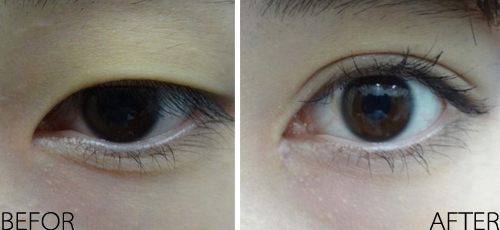 商丘割雙眼皮恢復(fù)快嗎？（圖）_1