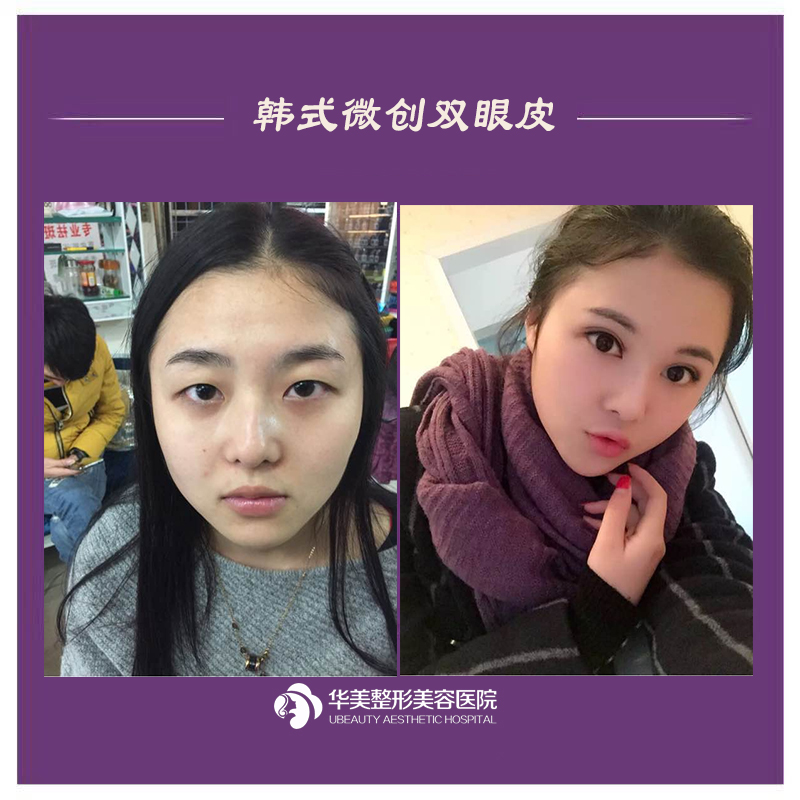 商丘華美整形雙眼皮多少錢？貴不貴？（圖）_1