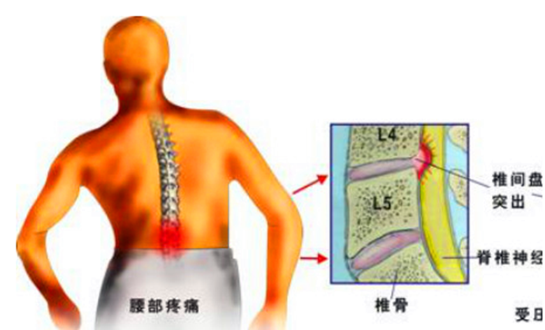 專家教你如何有效改善反復(fù)發(fā)作的腰椎間盤突出_1