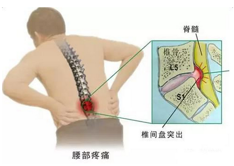 年紀輕輕怎么會腰間盤突出？該如何養(yǎng)護？_2