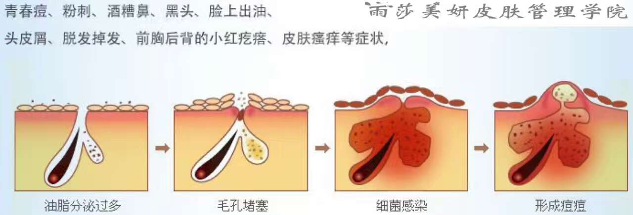 皮膚管理培訓中心皮膚管理解決的8大皮膚問題（圖）_3