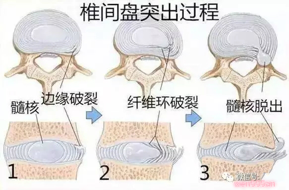 記住這6不要能有效緩解腰椎間盤突出?。▓D）_1