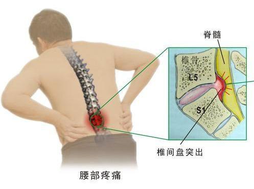 腰椎間盤突出不開刀不手術(shù)就能改善好！_1