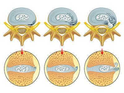 腰椎間盤突出不開刀不手術(shù)就能改善好！_4