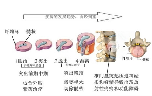 腰椎間盤突出腿疼麻怎么治最好，關(guān)注這一點_2