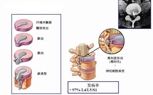 尽早明了腰突危害 趁早选择正确的改善方案_1