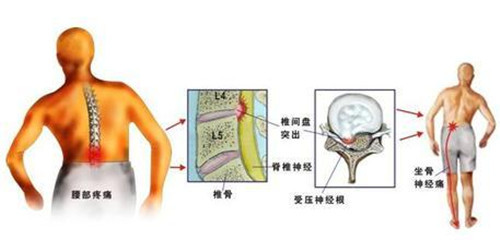 腰椎间盘突出压迫神经造成腿疼麻木怎么治效果好_3