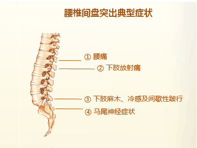 屁股疼腿疼怎么治有效，用王九正_2