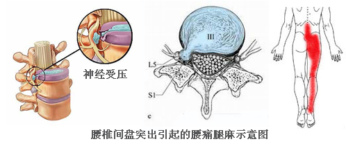 腰椎间盘突出使用保守改善外贴方法效果好不好？_2