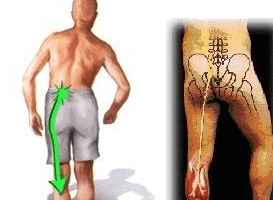 喬氏黑玉膏真的可以改善坐骨神經(jīng)痛嗎 看這里（圖）_1