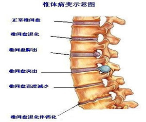 “不死癌症”腰间盘突出的改善良方乔氏黑玉膏_2