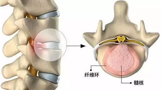 改善腰间盘突出一定要懂的方法在家就能做！_2