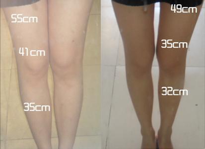 射頻溶脂減肥儀器（圖）_1