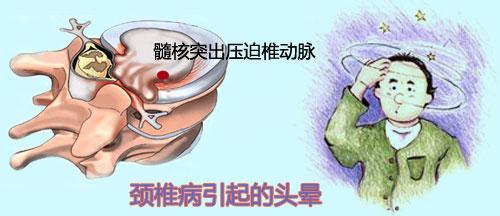 用什么方法可以治好頸椎病頭暈?zāi)?？_1