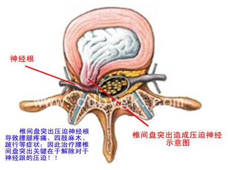 哪里看腰椎間盤(pán)突出效果最好呢？_3