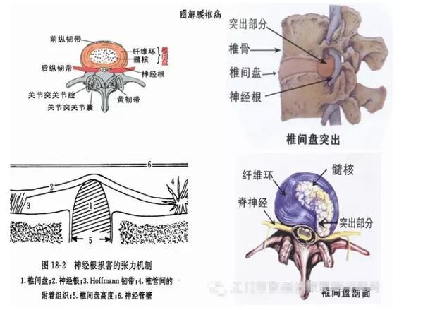 怎樣改善腰椎疼痛才能有效根除？_1