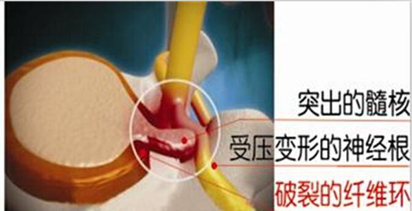 腰間盤突出的自我療法介紹 都說王九正最管用_2